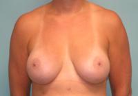 Breast Surgery  Case 821 - Breast Augmentation