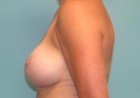 Breast Surgery  Case 821 - Breast Augmentation