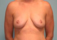 Breast Surgery  Case 821 - Breast Augmentation