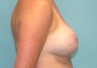 Breast Surgery  Case 821 - Breast Augmentation