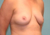 Breast Surgery  Case 821 - Breast Augmentation