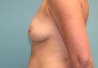 Breast Surgery  Case 821 - Breast Augmentation