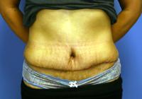 Body Contouring  Case 841 - Tummy Tuck