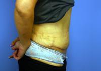 Body Contouring  Case 841 - Tummy Tuck