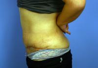 Body Contouring  Case 841 - Tummy Tuck