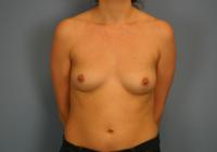 Breast Surgery  Case 851 - Breast Augmentation