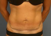 Body Contouring  Case 901 - Tummy Tuck