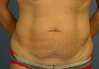 Body Contouring  Case 901 - Tummy Tuck