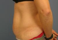 Body Contouring  Case 901 - Tummy Tuck