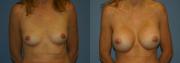 Breast Augmentation