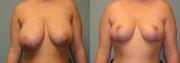 Breast Reduction