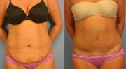 Tummy Tuck