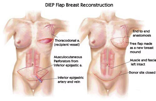 deip breast reconstruction Deip breast reconstruction