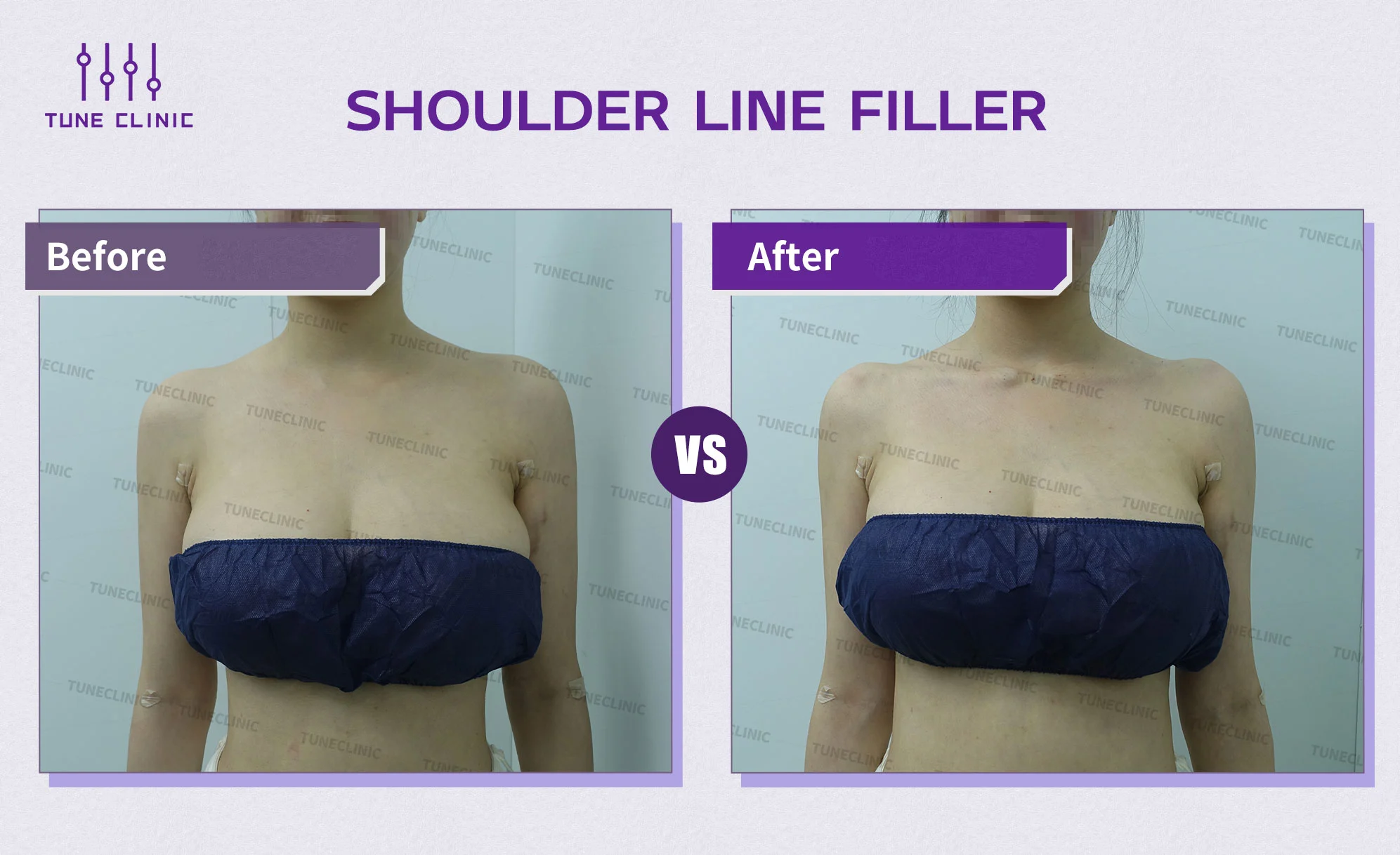 Before and after — Shoulder Line Filler