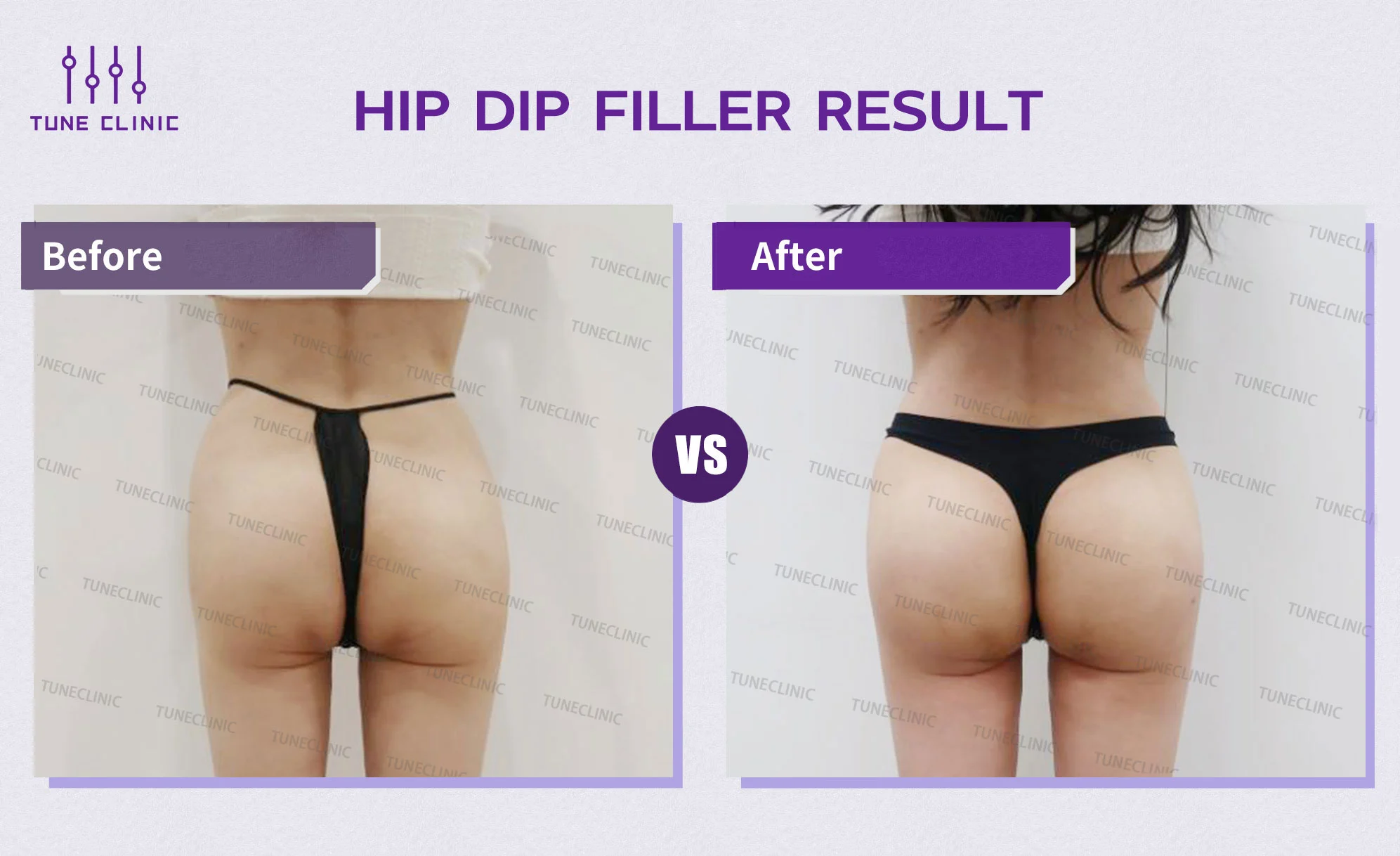 Before and after — Hip Dip Correction