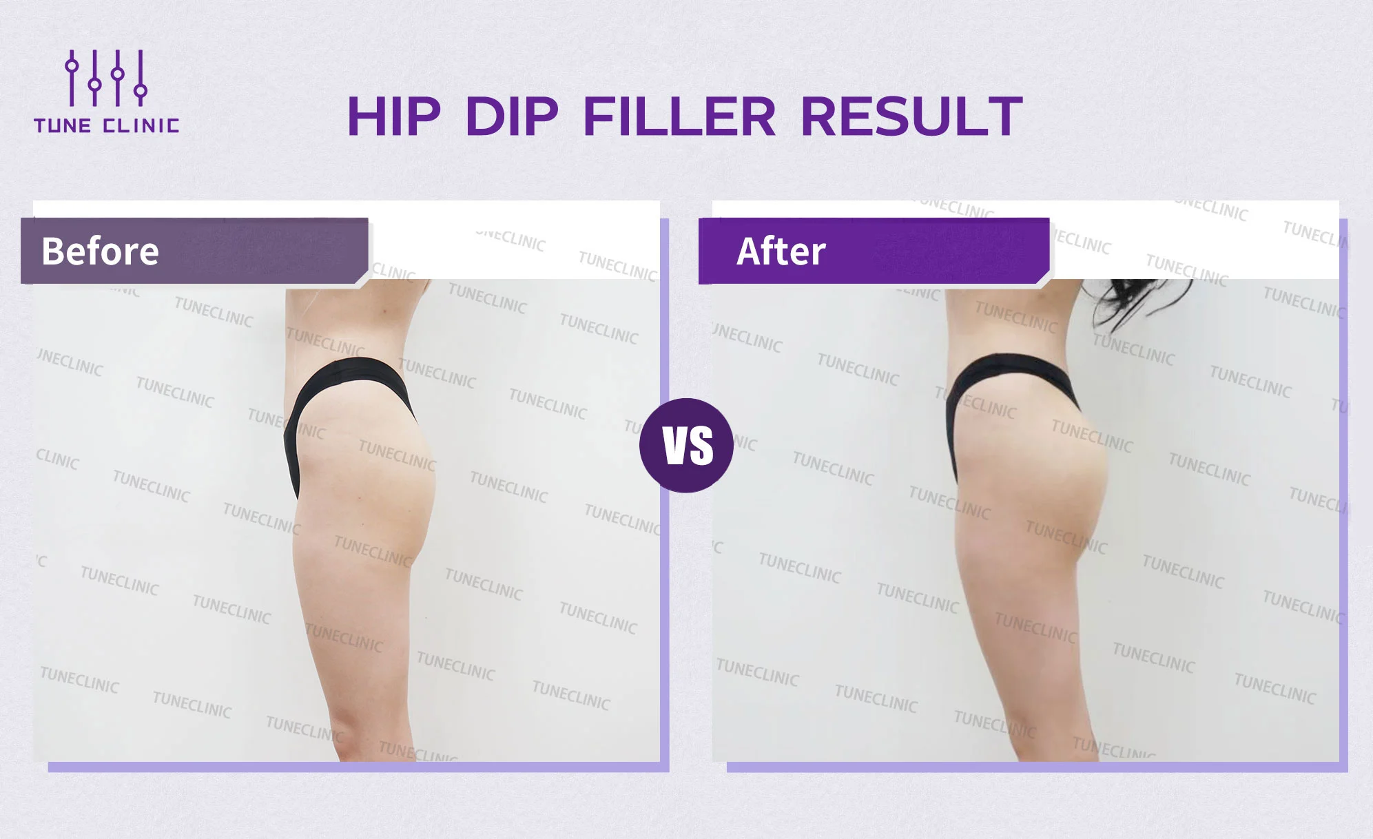 Before and after — Hip Dip Correction