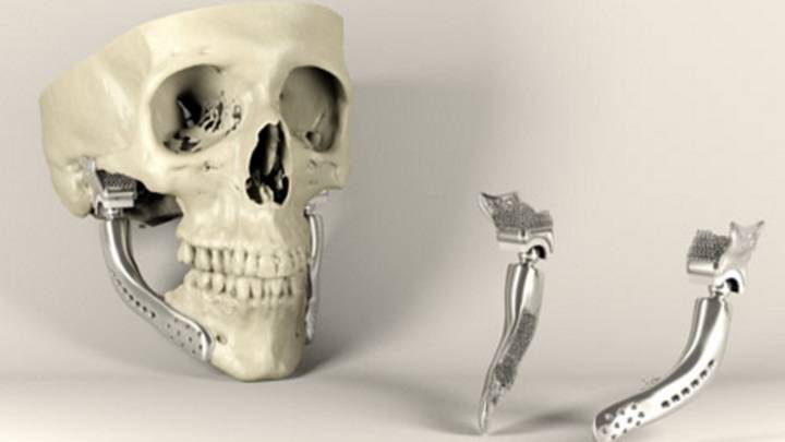 3D-Printed Bioabsorbable Bone Implant | Plugon