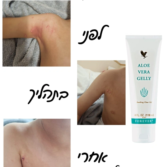 טיפול ביבלות ויראליות לפני ו 3 חודשים אחרי