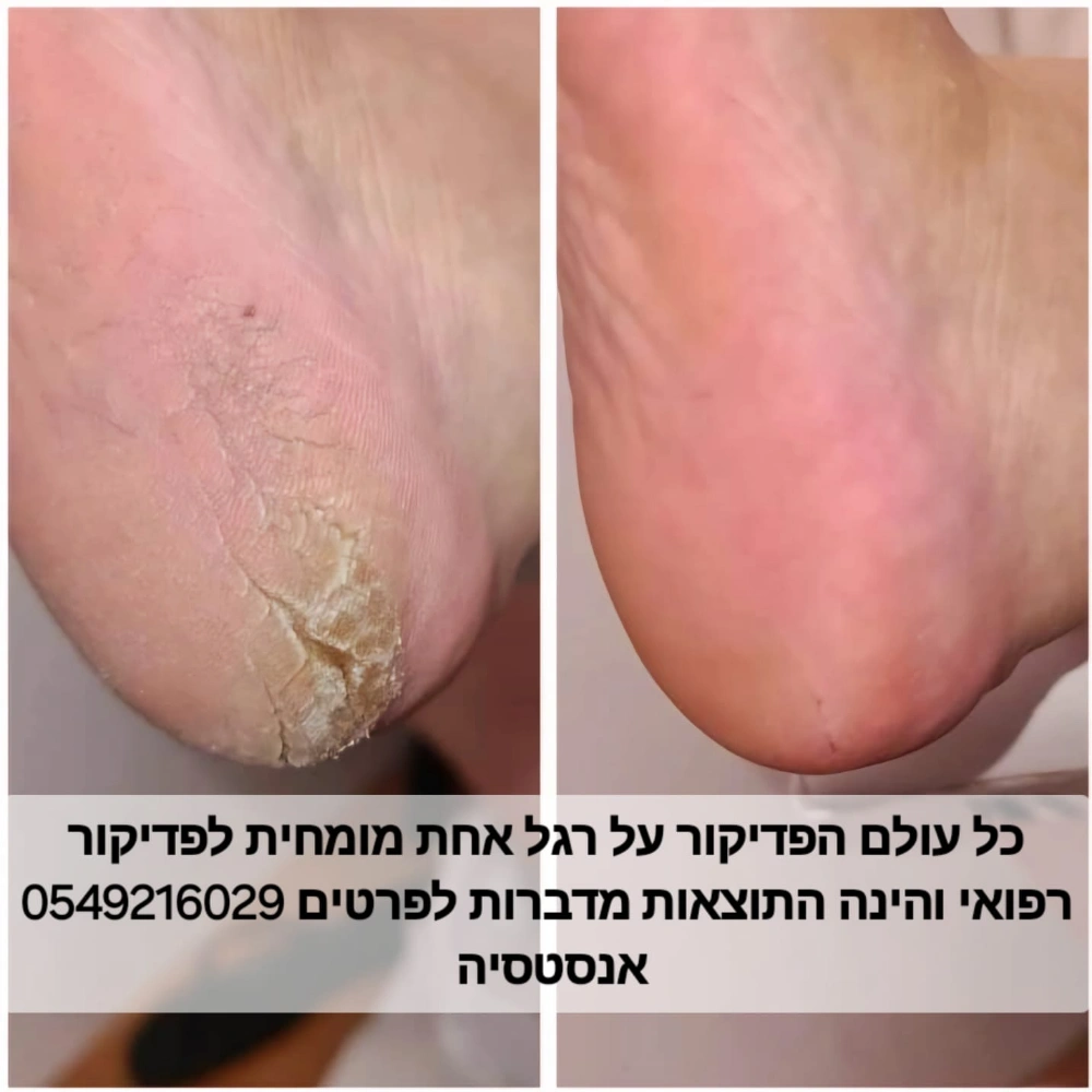גלרית תמונות טיפול פדיקור רפואי -חולי סוכרת יבלות טיפול לפני ואחרי לתוצאה מושלמת ביותר