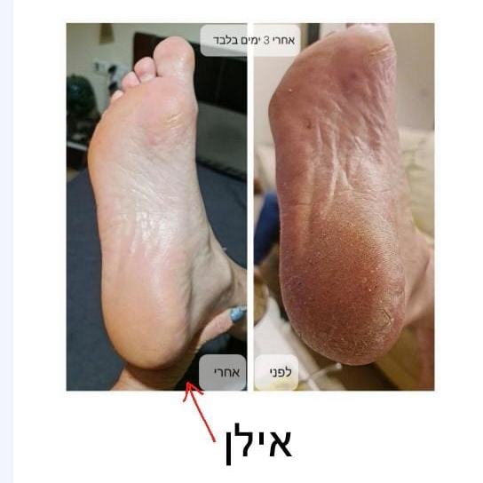 לפני ואחרי טיפול בכף הרגל בעזרת האלו-סקראב