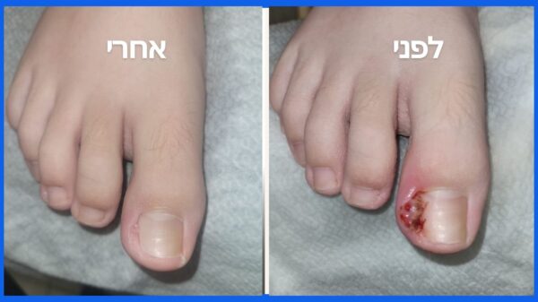 טיפול בציפורן חודרנית עם מומחית לשיקום כף הרגל לפתרון הבעייה באופן סופי באחריות 