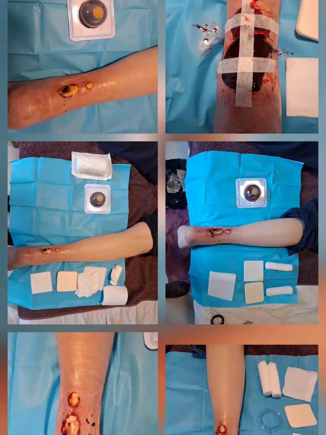 ביצוע חבישה ביולוגית Acti Graft