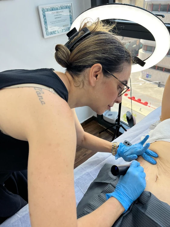 טיפולים לטישטוש סימני מתיחה וצלקות בשתי שיטות: קמופלאז' ו- MCA