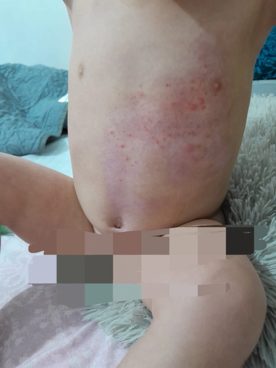 קצב ריפוי בלתי נתפס - כוויה לתינוק שנשפך עליו מים חמים