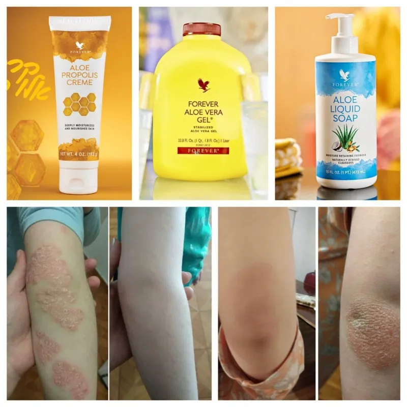 טיפול באטופיק דרמטיטיס