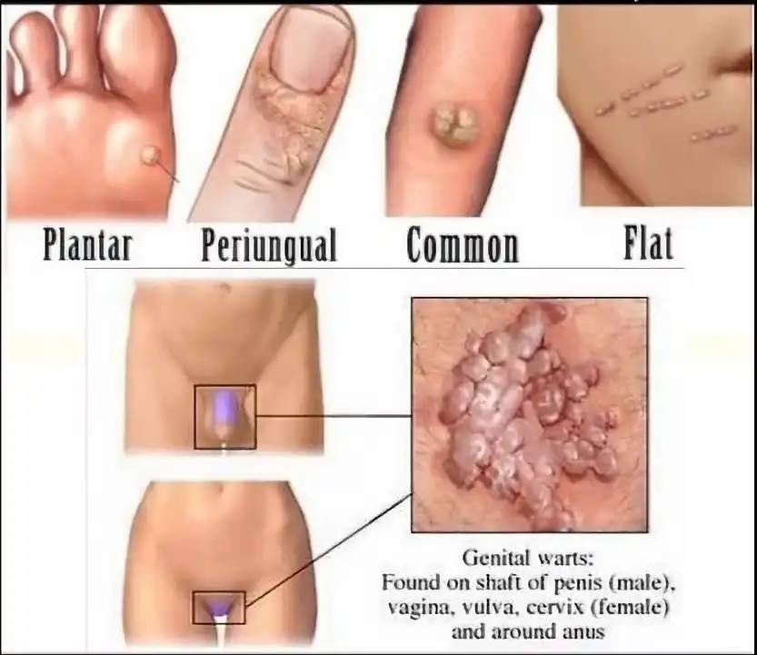 טיפול בקונדילומה שנוצרת מוירוס הפפילומה האנושי