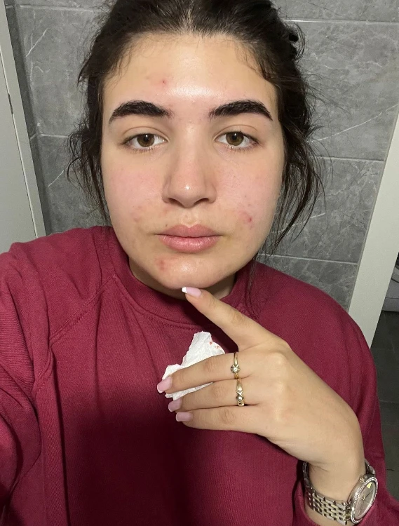 חבילת אקנה בייסיק