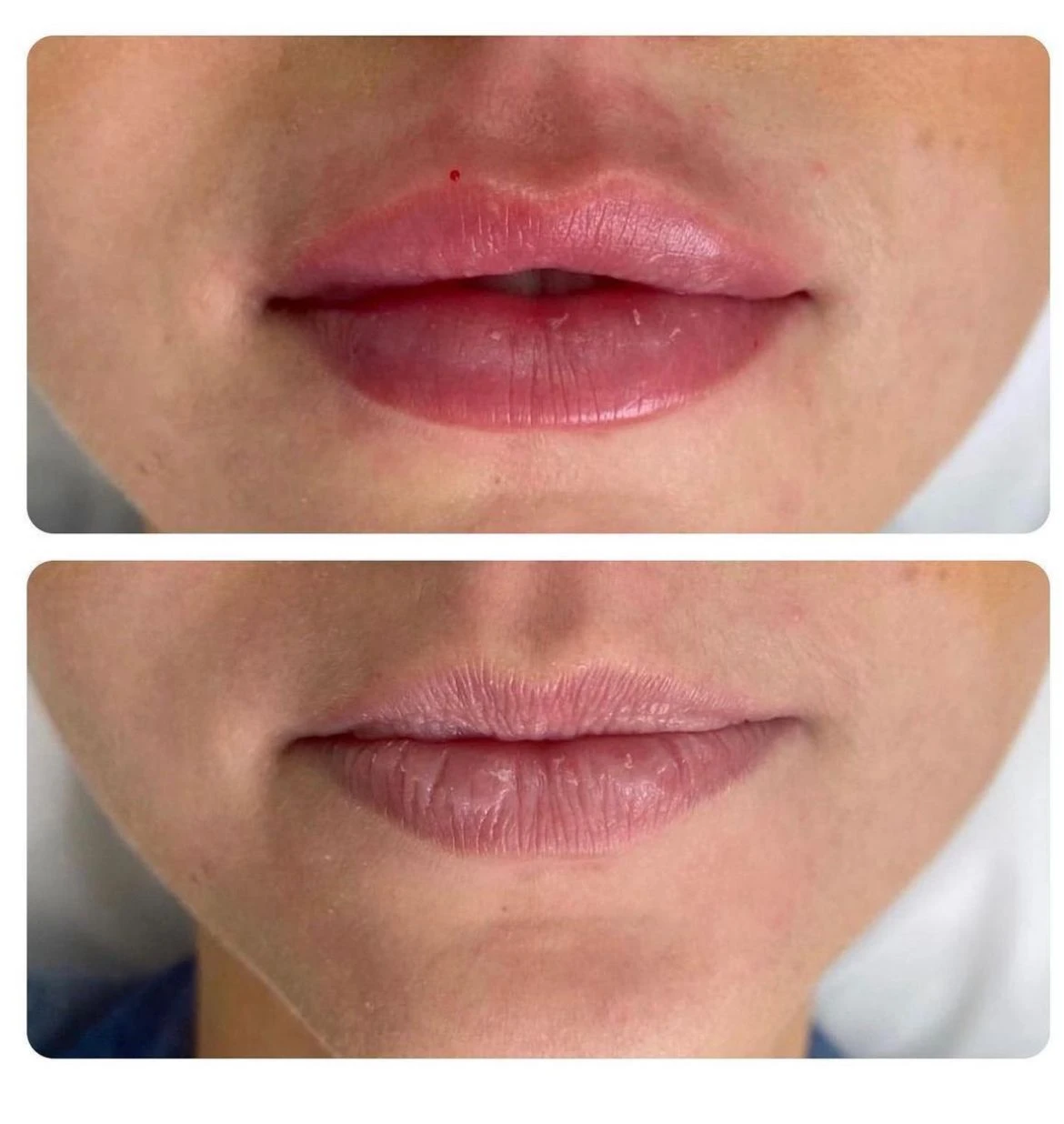 טיפולי אסתטיקה (הזרקות)