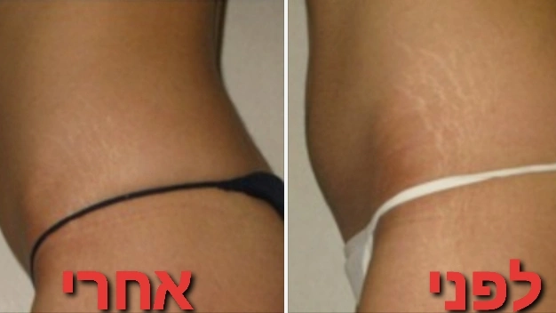 טיפולים לטישטוש סימני מתיחה וצלקות