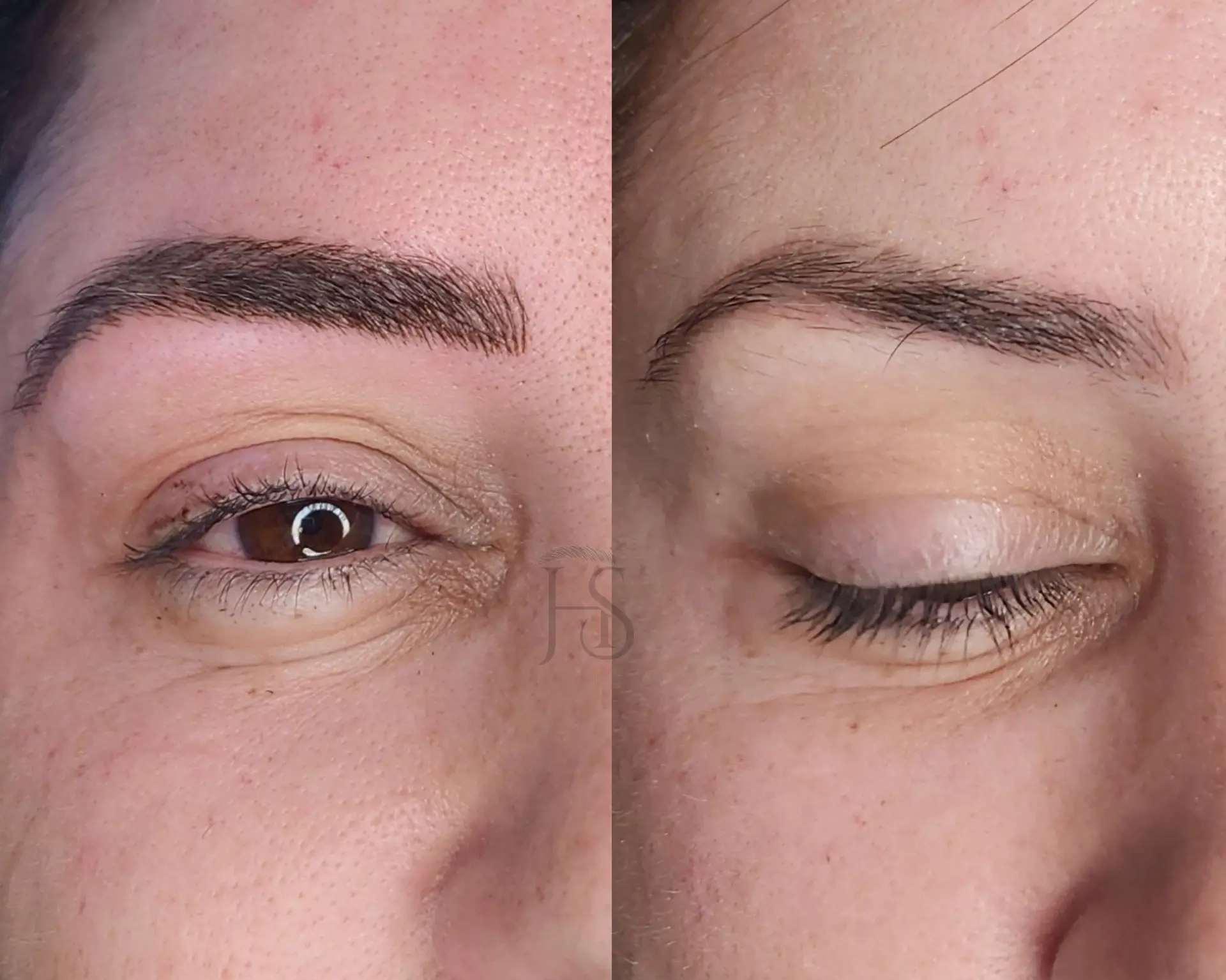 מיקרובליידינג