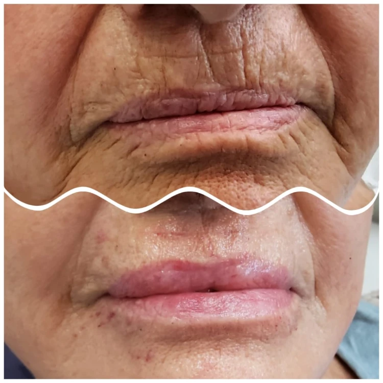 מילוי קמטים