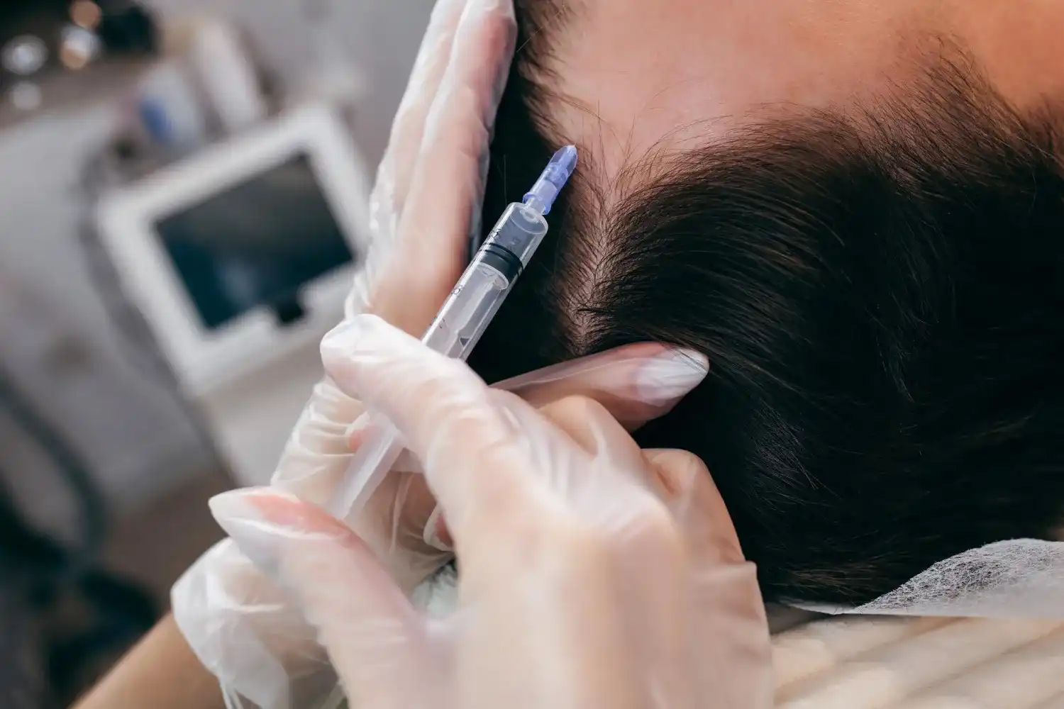 טיפול PRP לשיער בצפון – חיזוק טבעי לצמיחה מחודשת