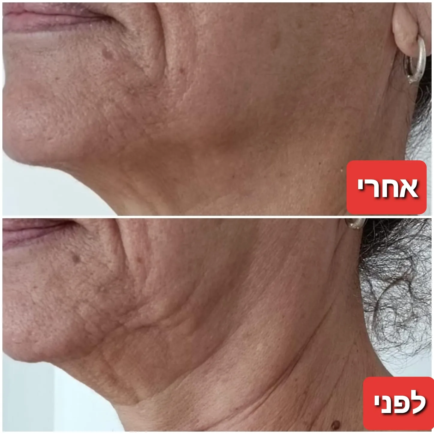 טיפולי פנים: אנטי אייגי'נג + גלי רדיו RF + מזותרפיה