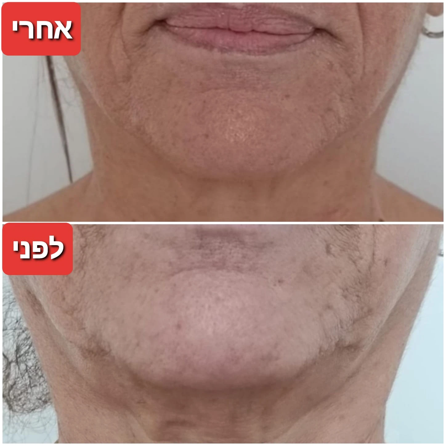 טיפולי פנים: אנטי אייגי'נג + גלי רדיו RF + מזותרפיה