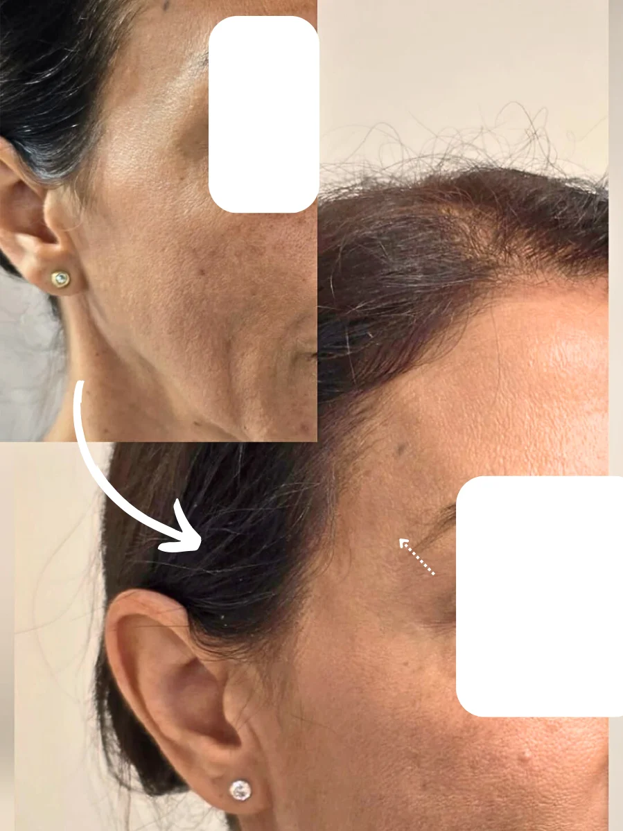 פיסול ועיצוב בחומצה היאלורונית