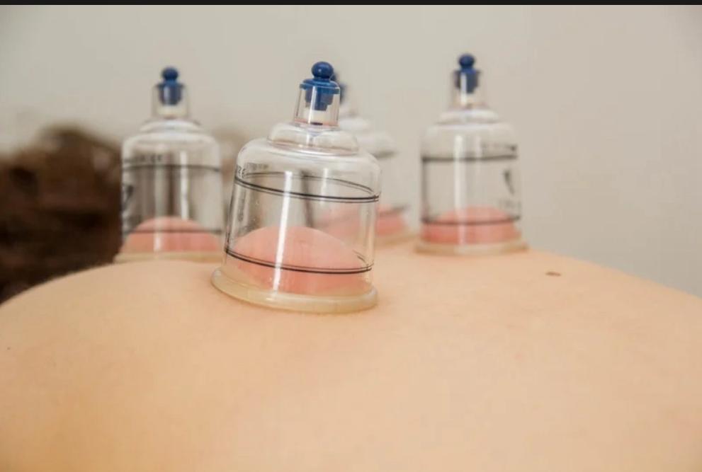 עיסוי שוודי עם כוסות רוח