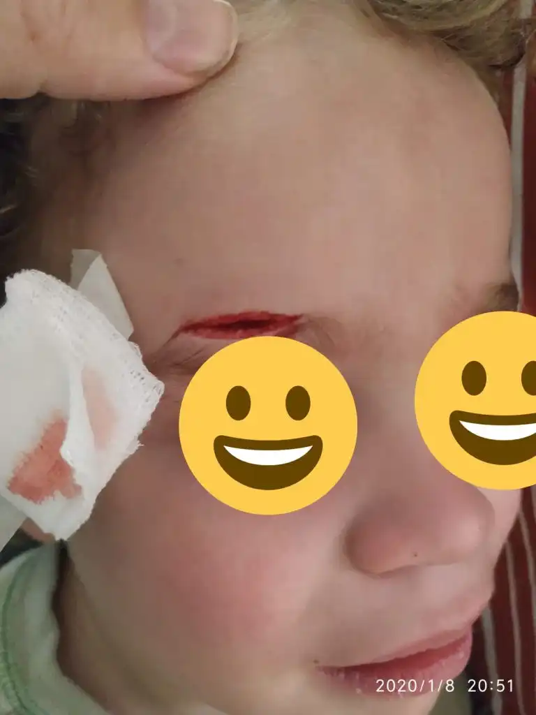 חתך מעל הגבה