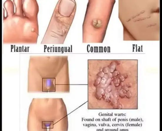 משחה לטיפול ביבלות קונדילומה לטיפול מקומי, 30 מל