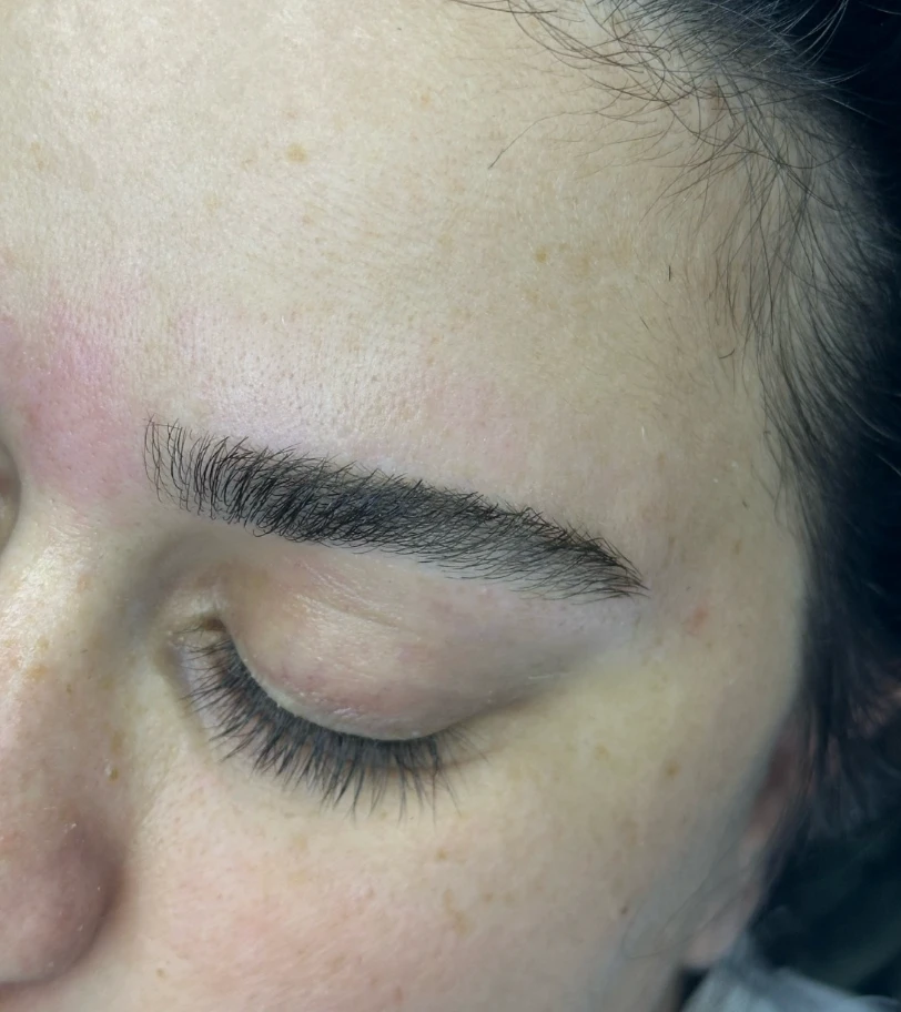 הרמת גבות (Brow Lift)