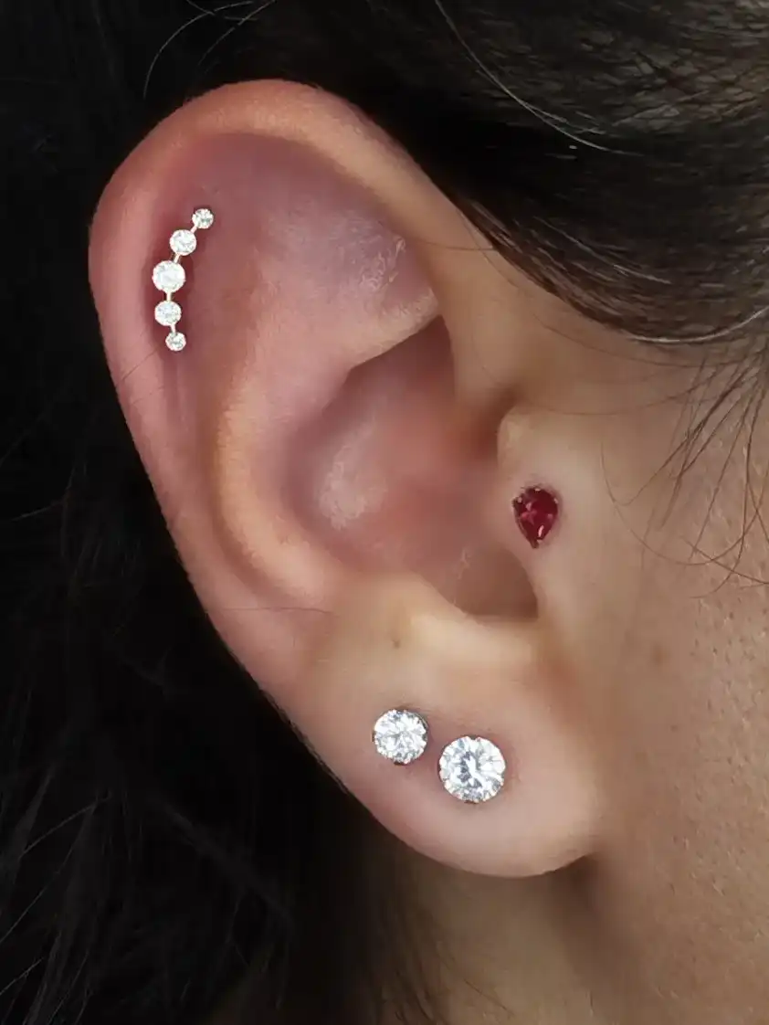 טראגוס ועיצוב אוזן