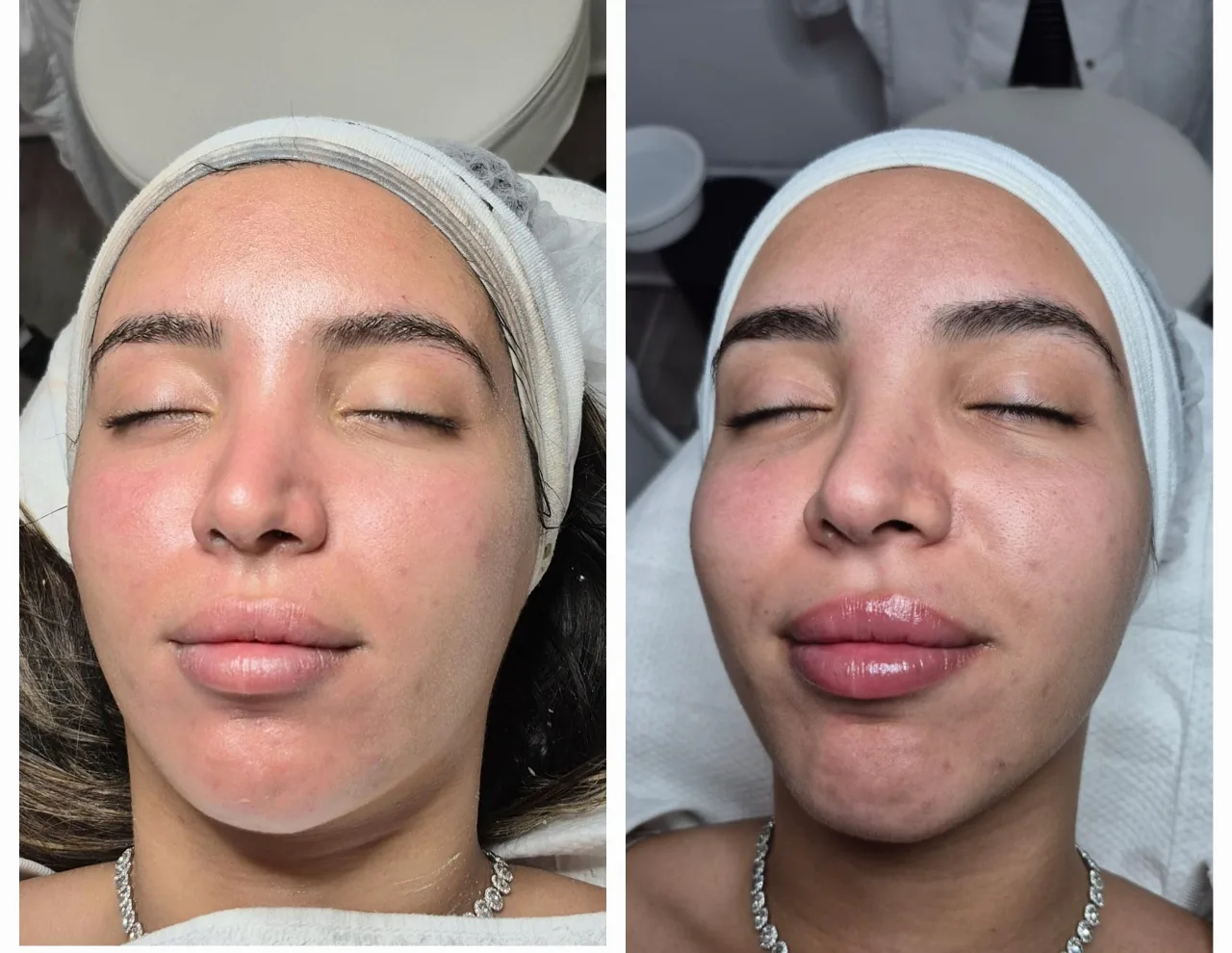  טיפול מיגור דלקת האקנה