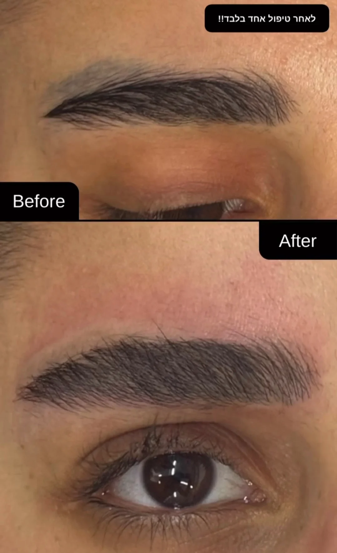 טיפולי לייזר להסרת איפור קבוע בגבות – המדריך המלא