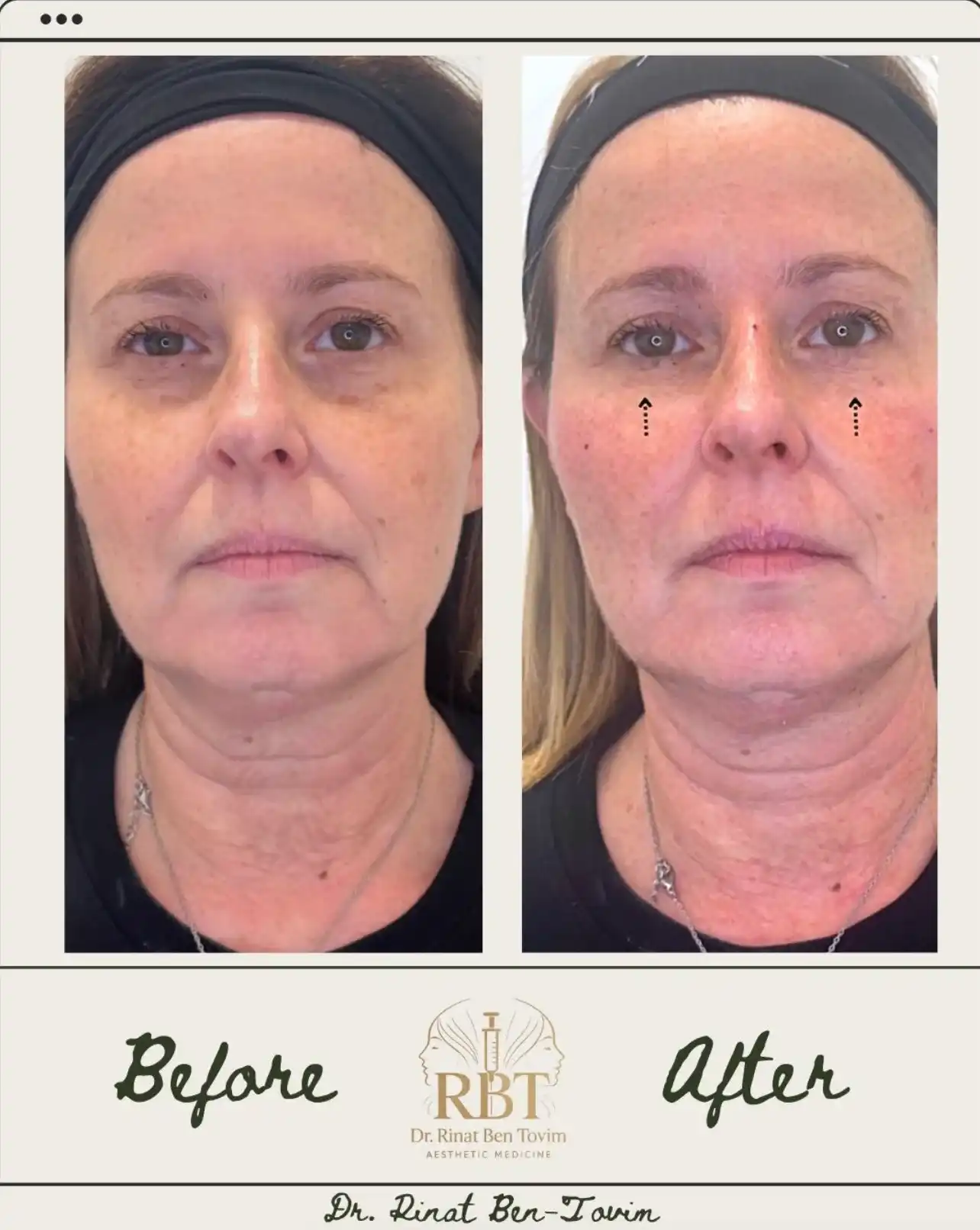 שקעי עיניים