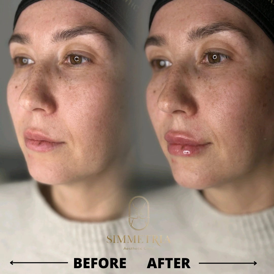 סקולפטרה/אולידיה/אסטפיל – טיפול צוואר