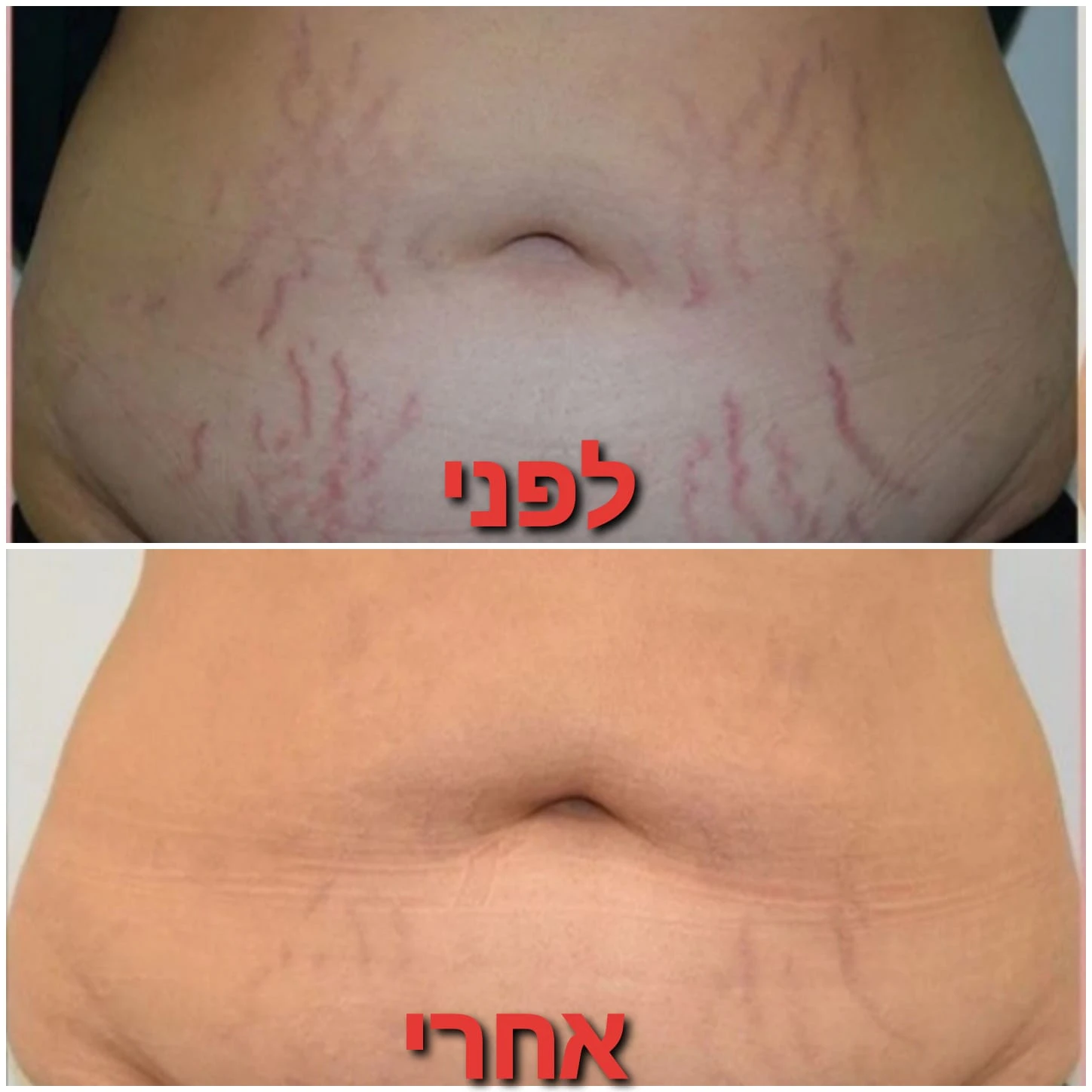 טיפולים לטישטוש סימני מתיחה וצלקות