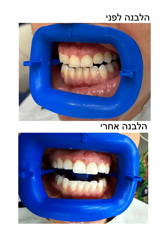 הלבנת שיניים